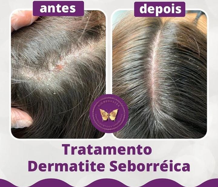 Antes e depois do tratamento Dermatite Seborreica