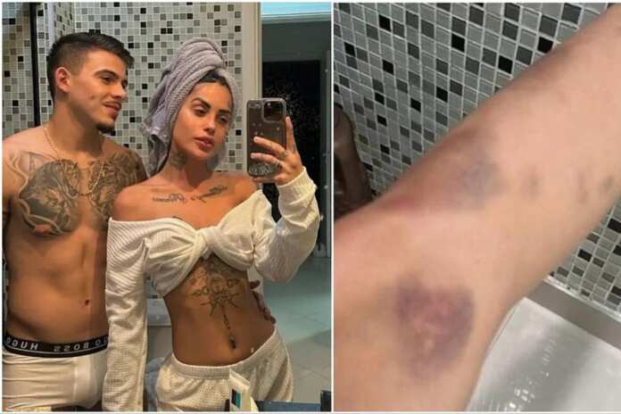 Thomaz Costa e Tati Zaqui trocaram acusações e a cantora exibiu ferimentos na perna – Foto: Reprodução/ Instagram @tatizaqui