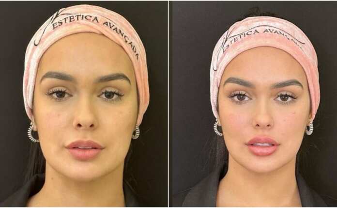 Ex-BBB Larissa Santos divide nas redes sociais o resultado de sua harmonização facial: “Eu estava me sentindo incomodada”