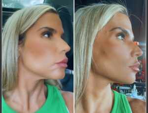 Taty Zatto faz novo procedimento estético no rosto; veja o antes e o depois