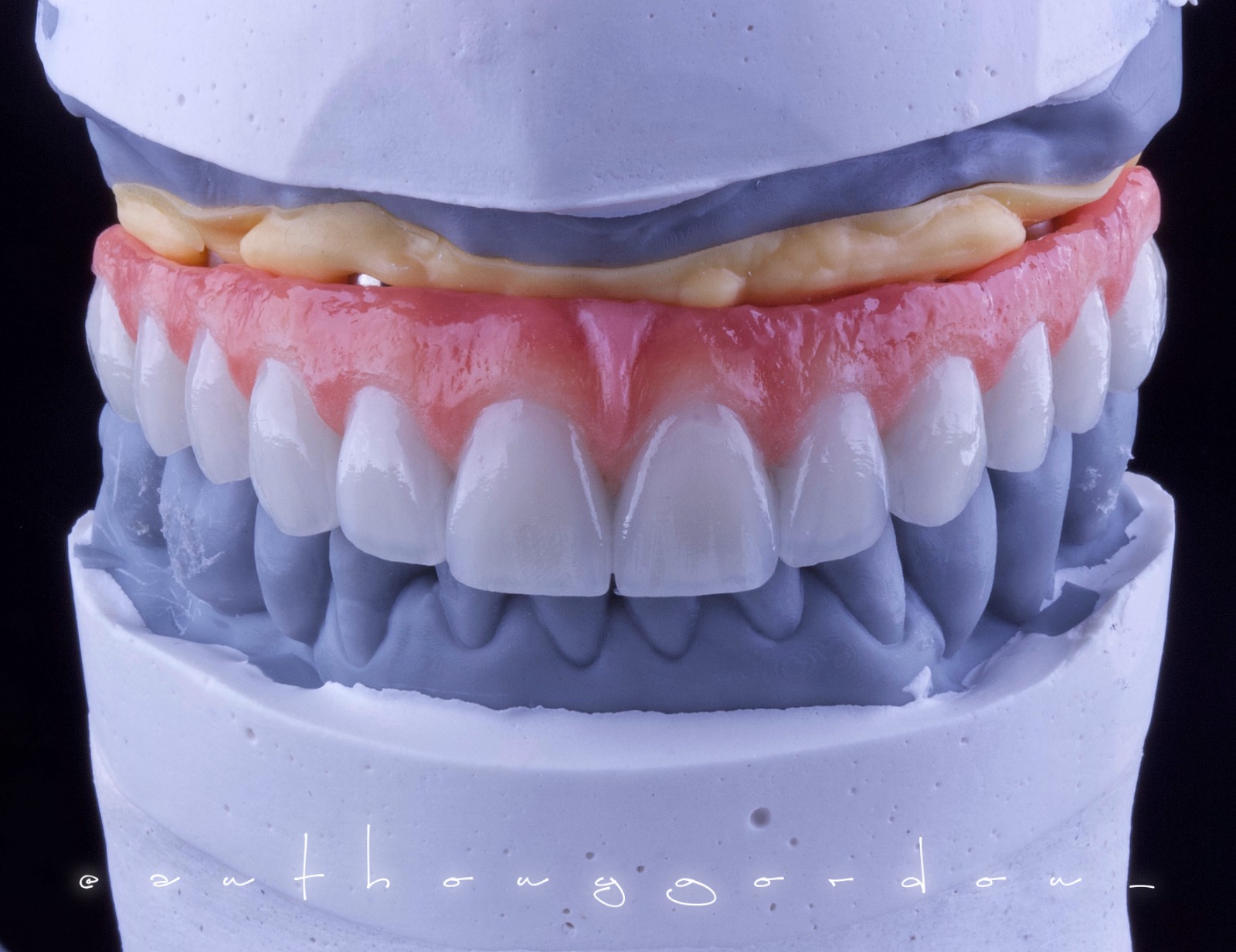 implantes dentários tipo protocolo