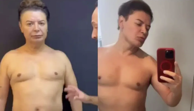 David Brazil mostra corpo um mês após lipoaspiração; veja antes e depois