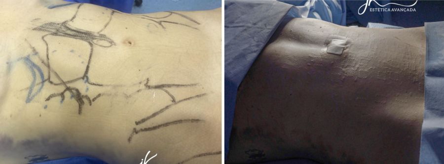 Sheila Mello antes e depois da cirurgia - Foto: Clínica JK Estética Avançada / Divulgação