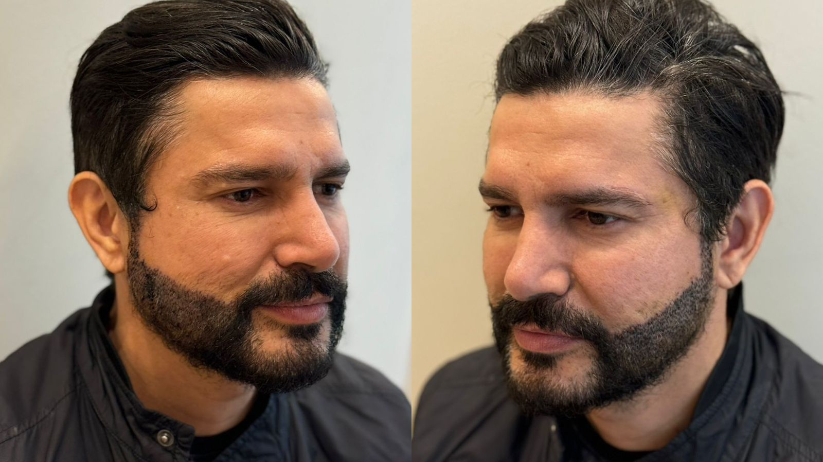 Cantor Zé Henrique após a realização do Transplante de Barba - Crédito da Foto: Divulgação