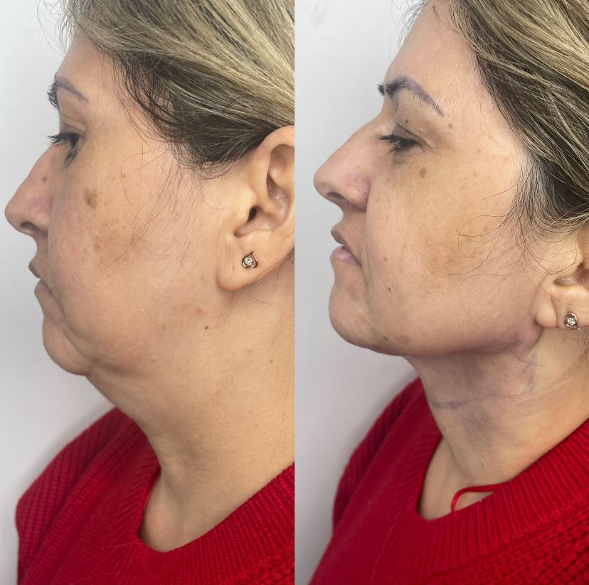 Dr. Lopez explica tudo sobre Lipo de Papada e Harmonização Facial 9 PHOTO 2025 03 11 02 21 26