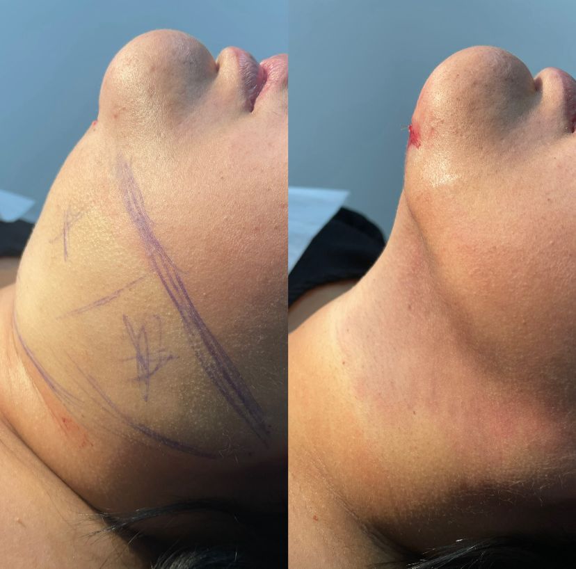 Dr. Lopez explica tudo sobre Lipo de Papada e Harmonização Facial 11 PHOTO 2025 03 11 02 21 41