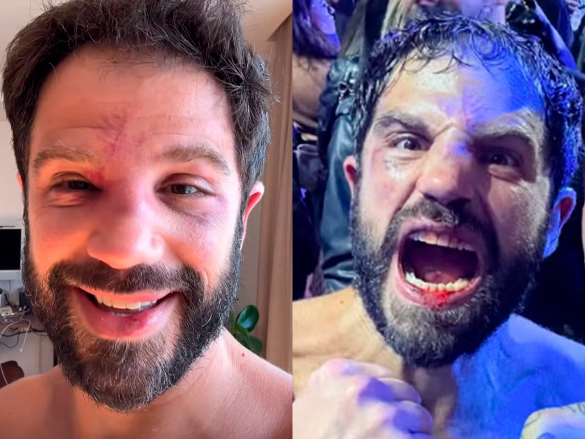 Duda Nagle Desabafa Após Derrota: &Quot;A Luta Me Deixou Meio Avariado&Quot; 2 Duda Nagle Exibe Hematomas Após Perder Luta Para Popó: “Meio Avariado” - Foto: Instagram