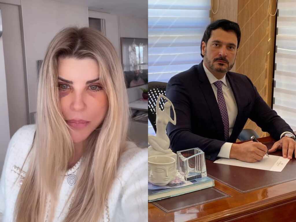 O que explica os hematomas de Iris Stefanelli após a cirurgia? Especialista esclarece IMG 20250624 WA00971