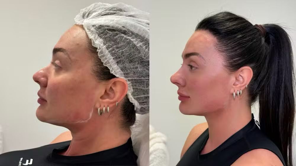 Juju Salimeni impressiona com antes e depois de procedimentos feitos pela Dra. Karlla Salles WhatsApp Image 2025 09 26 at 14.56.46
