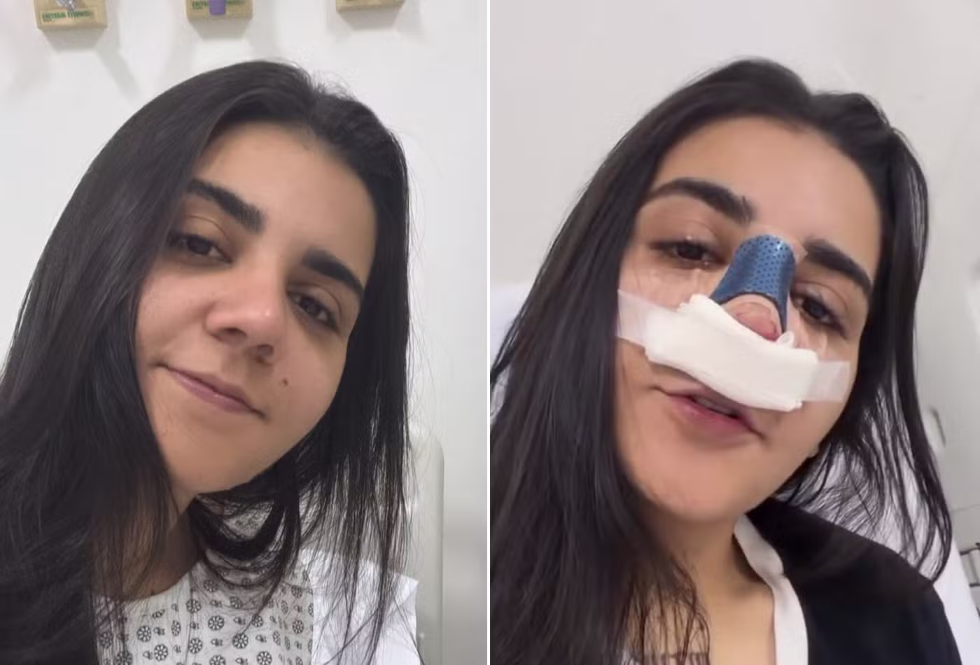Após término com Maria Venture, Yasmin Santos faz rinoplastia e explica motivo do procedimento