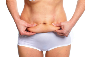 Abdominoplastia pós-bariátrica: especialista detalha como cirurgia moderna reconstrói contorno abdominal