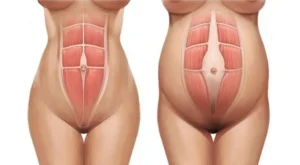 Dr. Octávio Curi Frascareli – Diástase abdominal: quando o problema vai além da estética