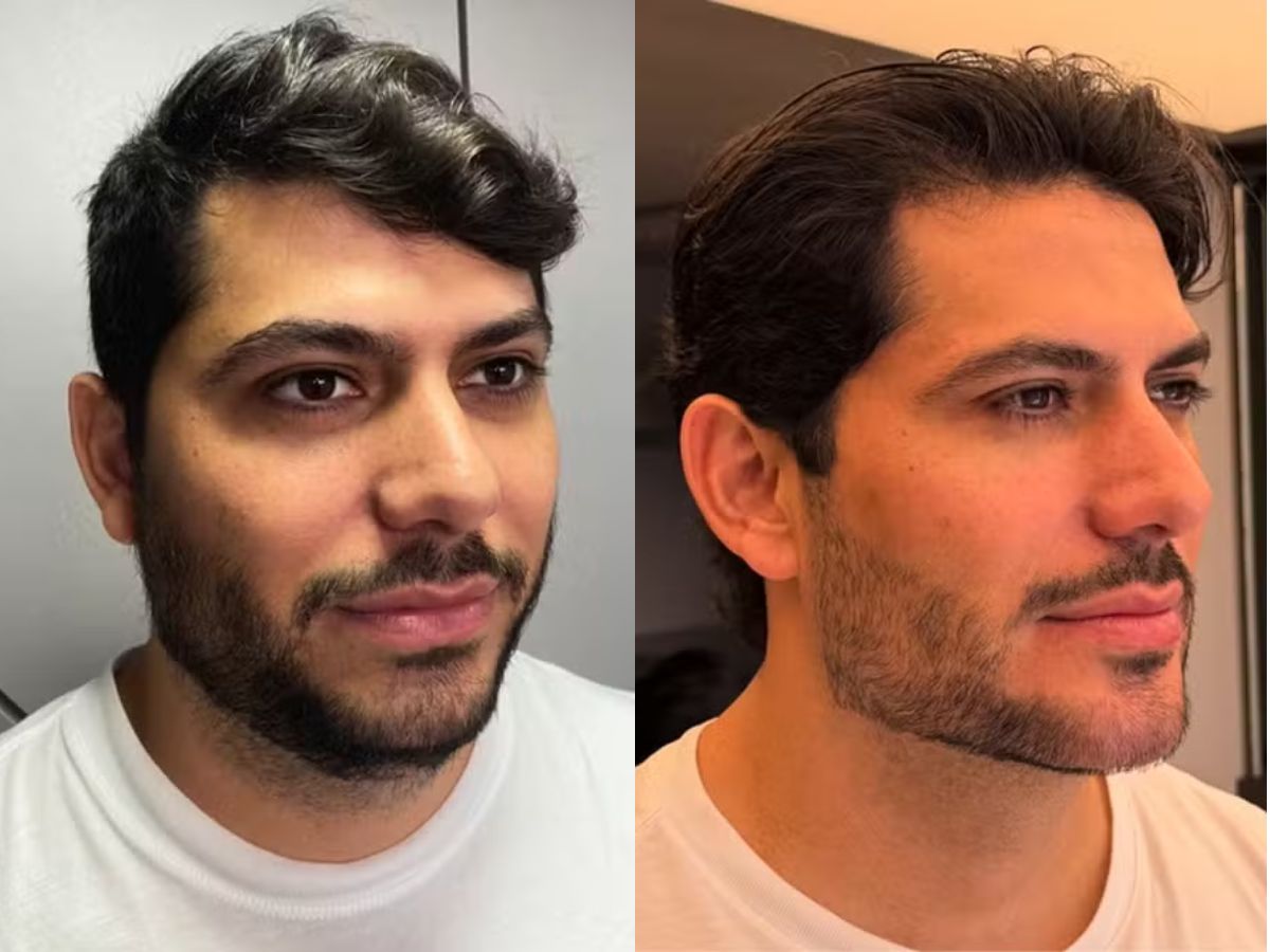 Mirela Janis exibe harmonização facial de Yugnir Ângelo e casal diverte web com vídeo de antes e depois - Foto: instagram