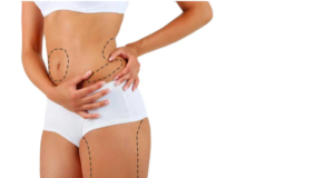 Lipoaspiração lidera a procura por cirurgias no verão e exige atenção especial no pós-operatório