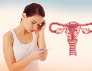 Endometriose e fertilidade: 7 pontos para entender a doença e quando a cirurgia é indicada