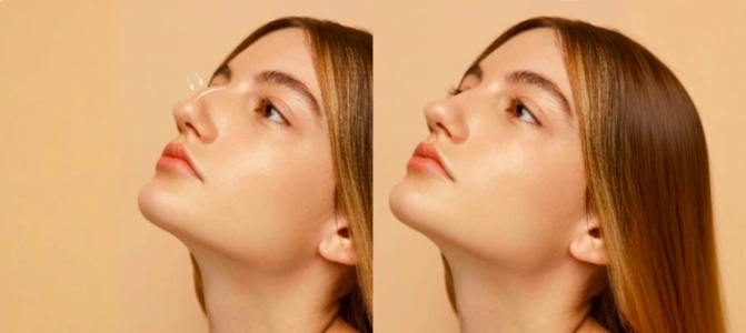 Especialista alerta para limites da rinomodelação e riscos graves do preenchimento nasal Captura de Tela 2026 02 03 as 15.35.17