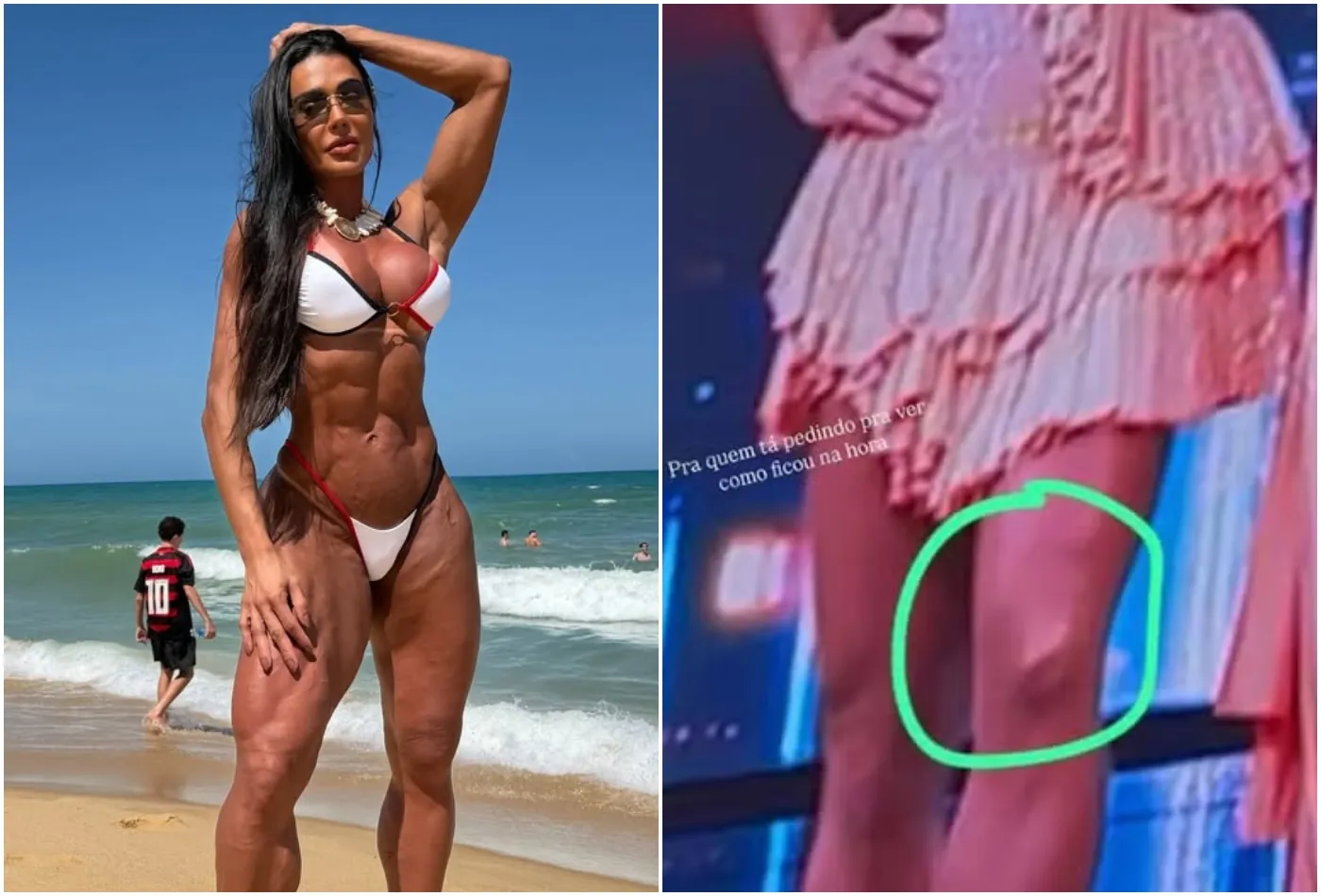 Gracyanne Barbosa detalha recuperação após lesão e revela desafios seis meses depois