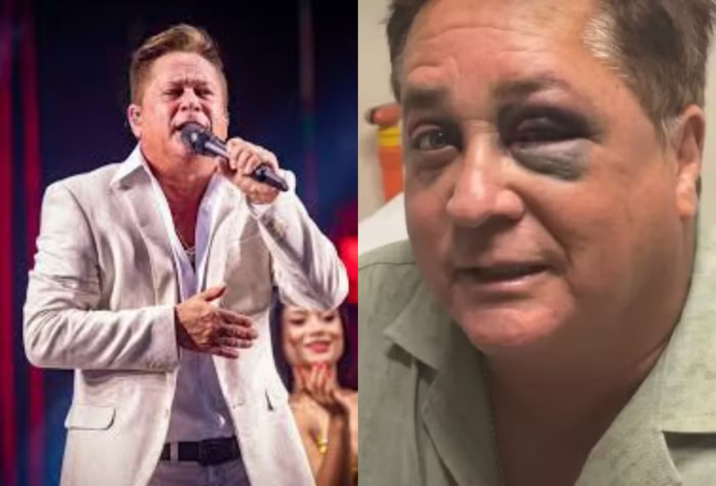 Leonardo detalha acidente que causou fratura no rosto e brinca sobre estar alcoolizado no momento Leonardo detalha acidente que causou fratura no rosto e brinca sobre estar alcoolizado no momento